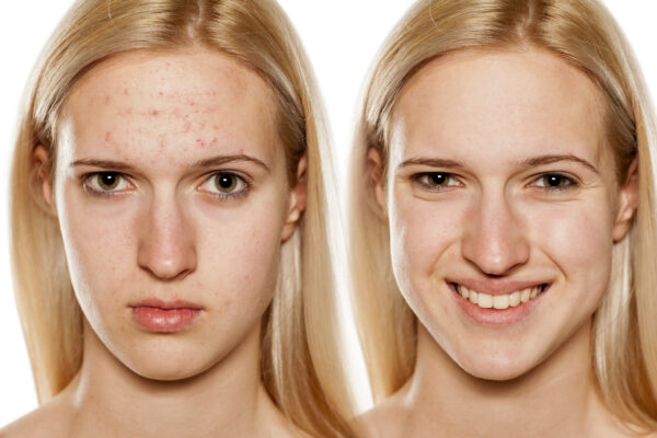 Acne Clarifying Facial